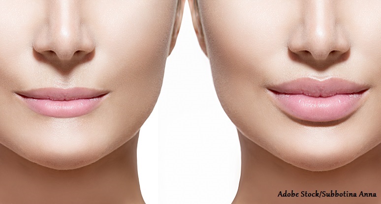 The Truth about Lip Fillers 